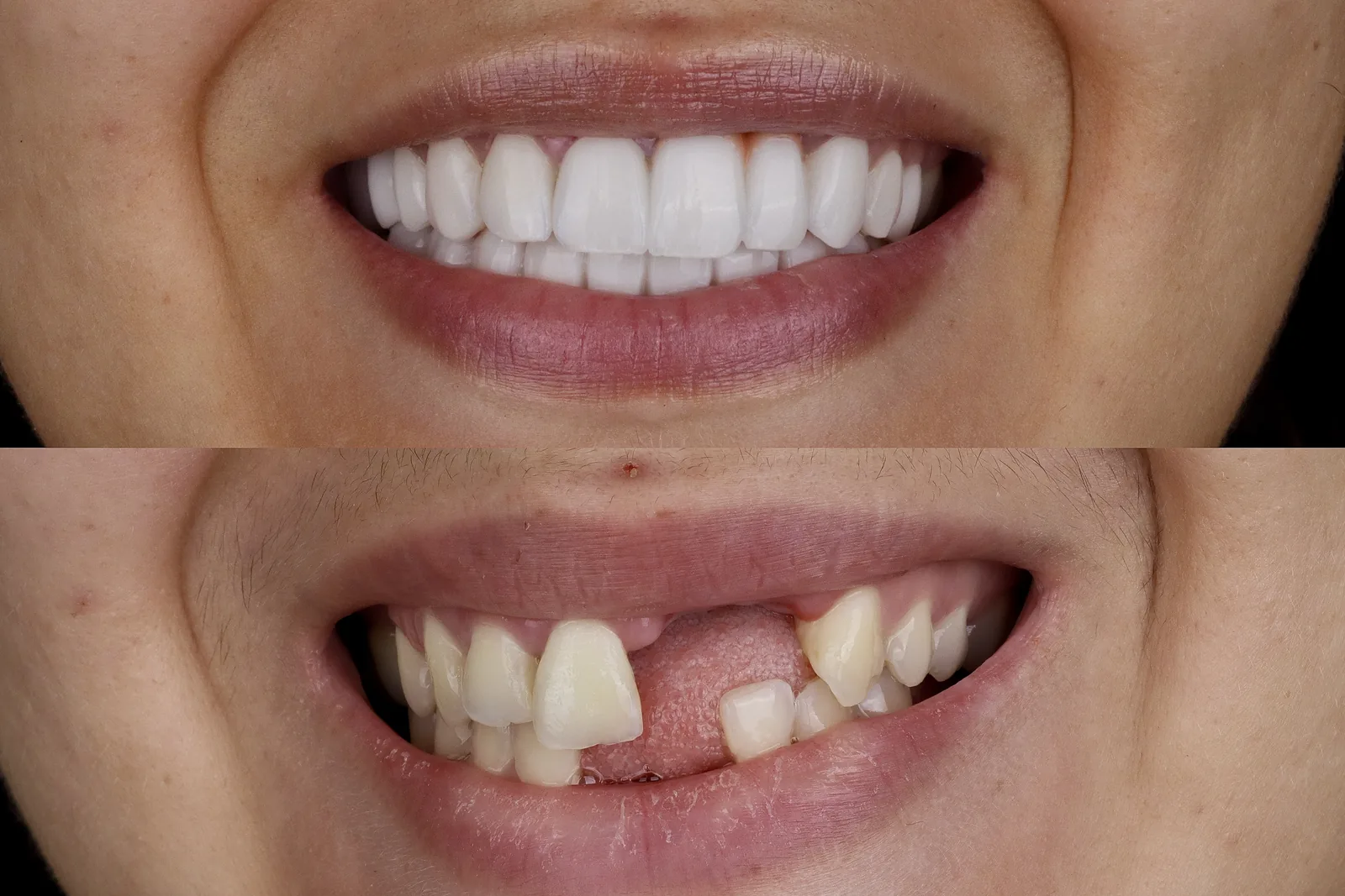 Before and after of a dental crown treatment in Medellín: fractured and missing upper front teeth fully restored