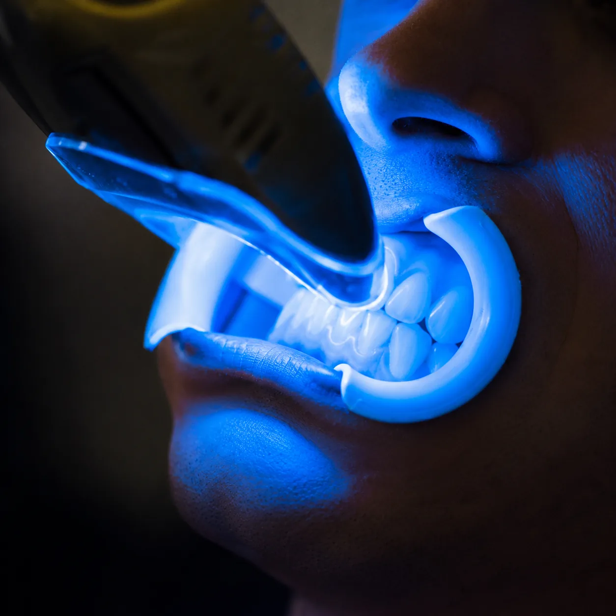 Laser teeth whitening treatment at Dra. Lesly Pinto's clinic in Medellín